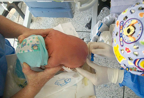 Ponction lombaire chez un nouveau-né infecté par des pneumocoques