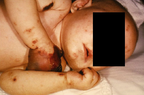 4 Monate altes Baby mit einer von Gangrän angegriffenen Hand während einer Meningokokkeninfektion