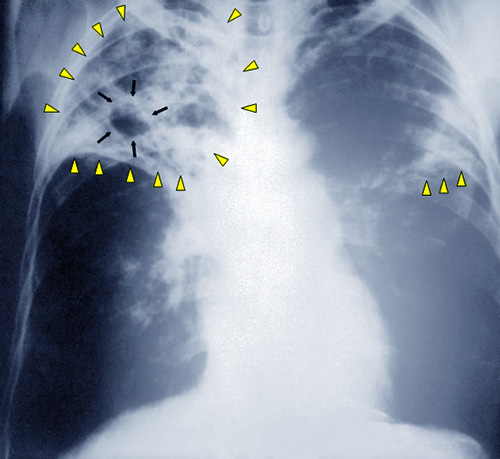 Radiographie des poumons d'un patient atteint de tuberculose.