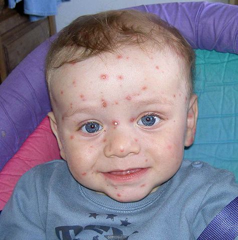 Visage d'enfant avec des boutons de varicelle